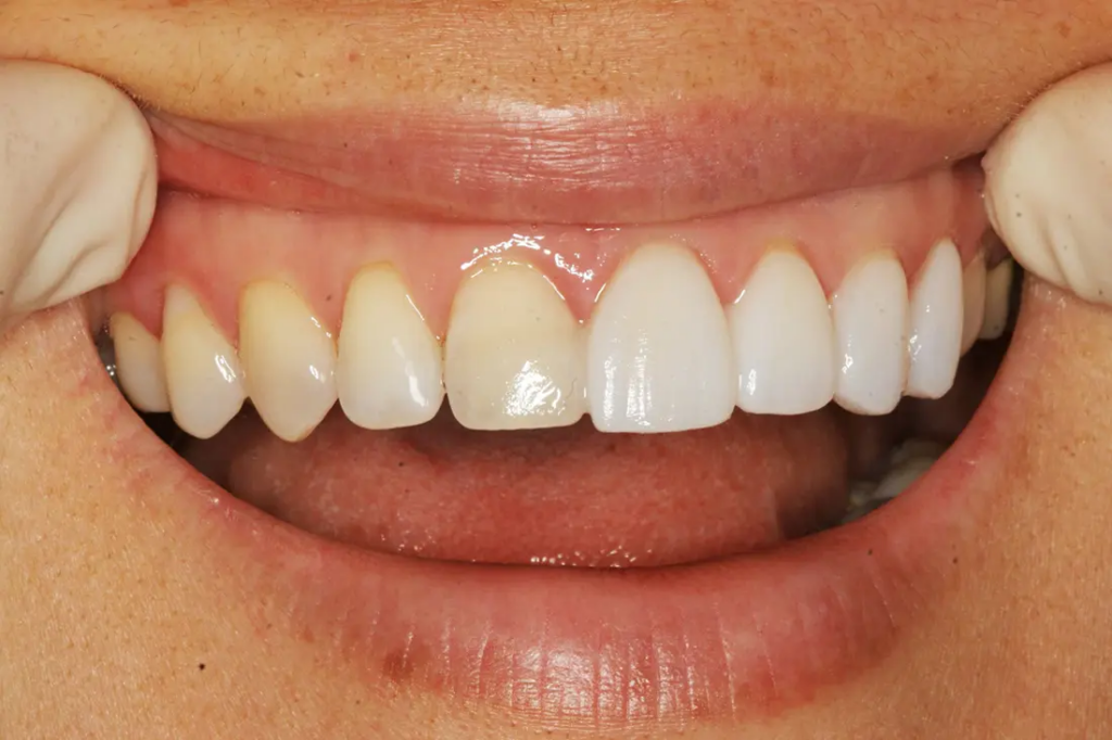 Veneers
