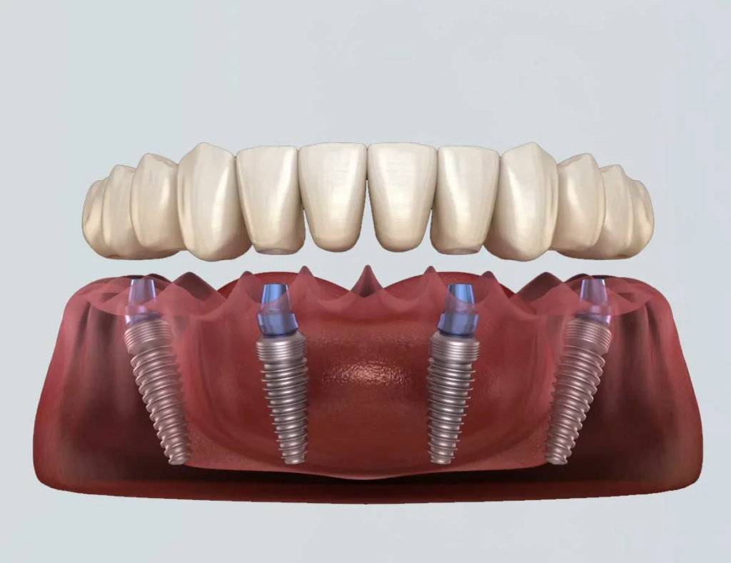 All-on-4 Dental Implants