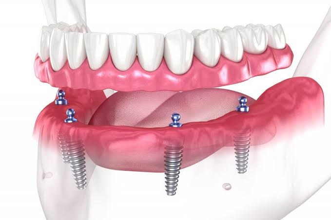 All on 4 Implants