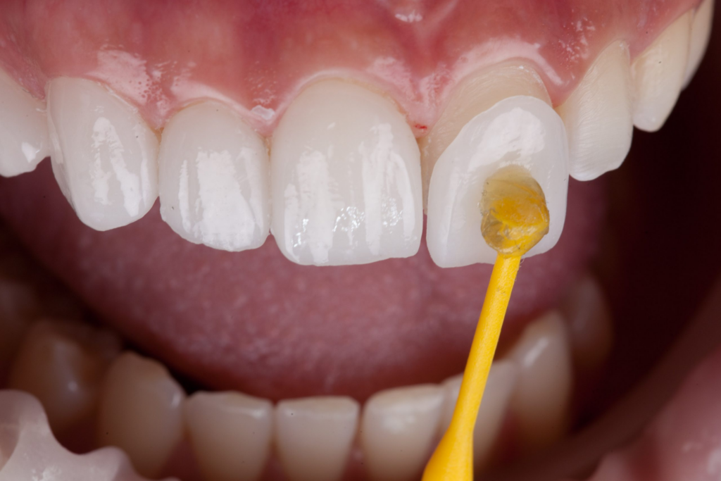 Veneers treatment