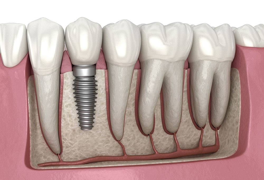 Dental-implants