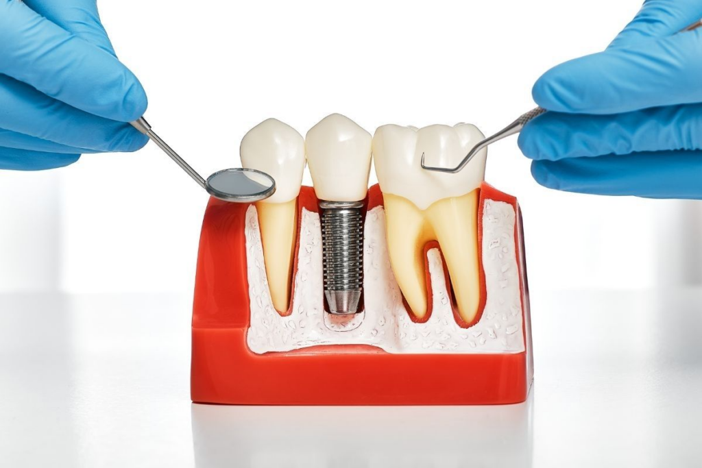 dental-implants