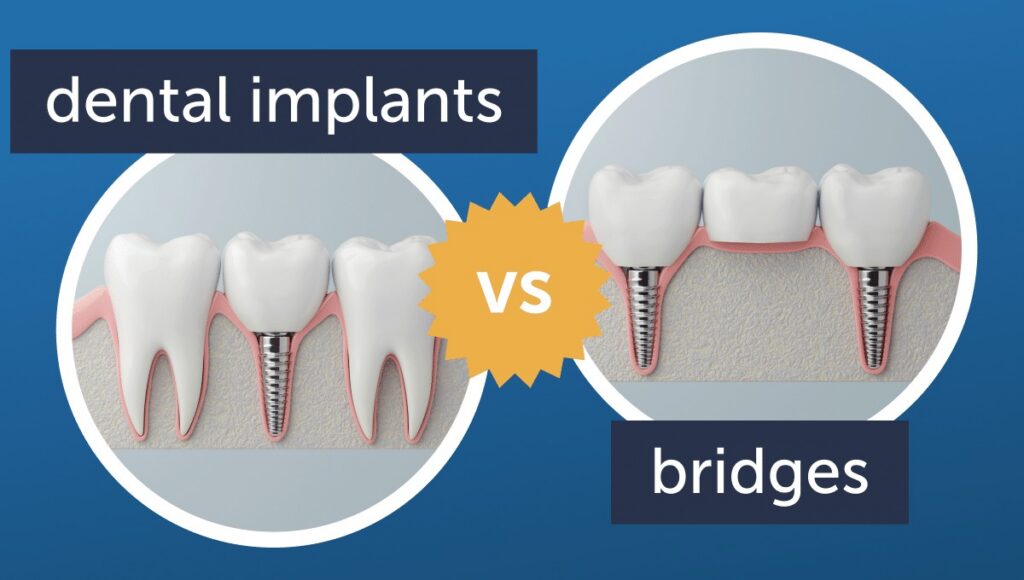 Single Tooth Implant vs. Bridge