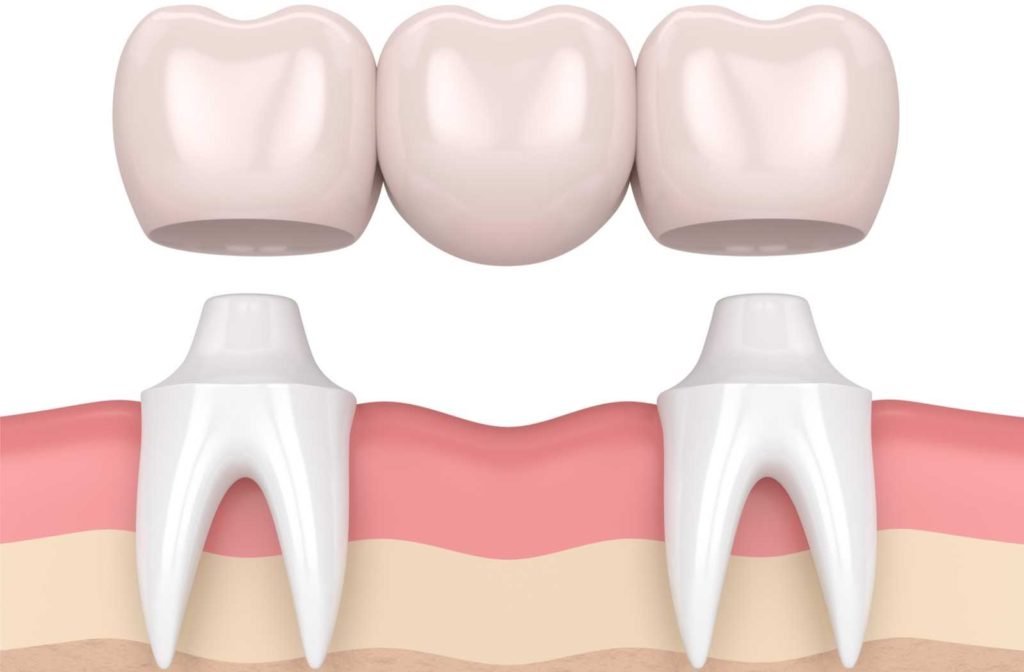 dental bridge
