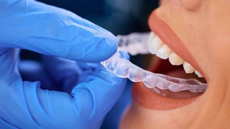 Invisalign