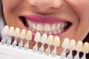 veneers Agoura Hills