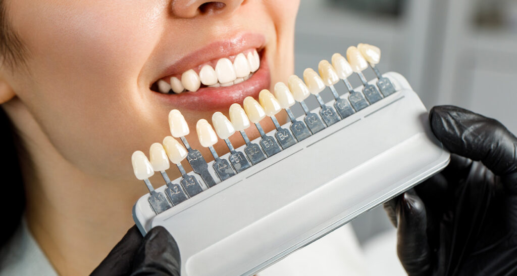 porcelain veneers Agoura Hills